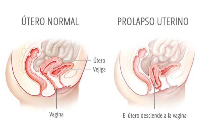 Prolapso e hipopresivos