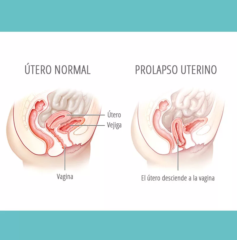 Prolapso e hipopresivos