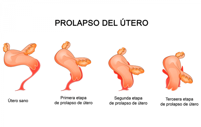 Problemas de suelo pélvico: el prolapso